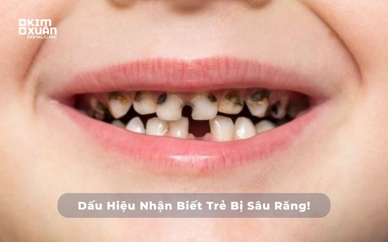 Hình Ảnh Dấu Hiệu Nhận Biết Sâu Răng