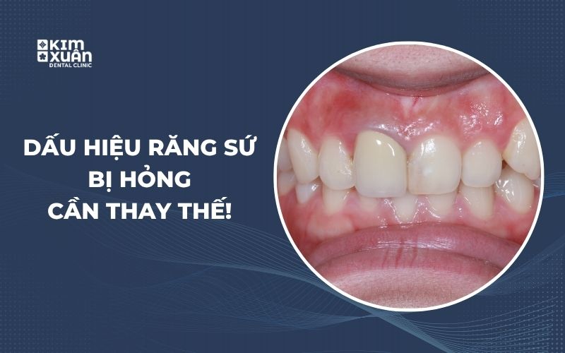 Hình Ảnh Dấu Hiệu Răng Sứ Bị Hỏng