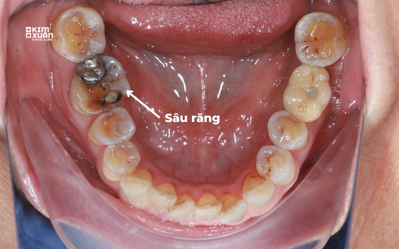 Hình ảnh dấu hiệu sâu răng