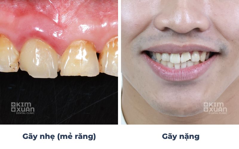 Hình Ảnh Gãy Răng Cửa 
