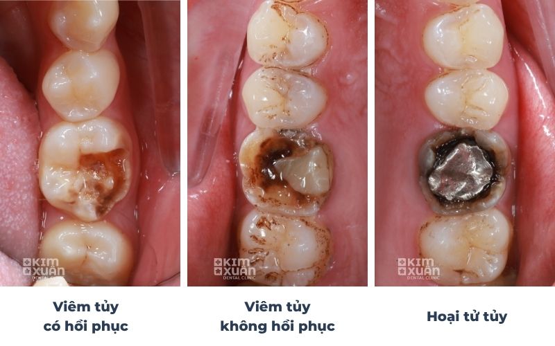 Các Giai Đoạn Răng Bị Thối Tủy