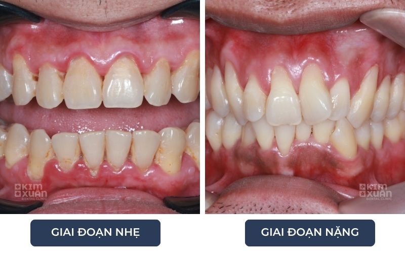 Hình Ảnh Tụt Lợi Theo Giai-Đoạn Từ Nhẹ Đến Nặng