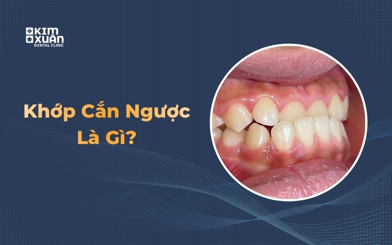 Hình ảnh khớp cắn ngược
