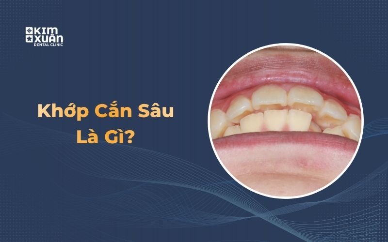 Hình ảnh khớp cắn sâu