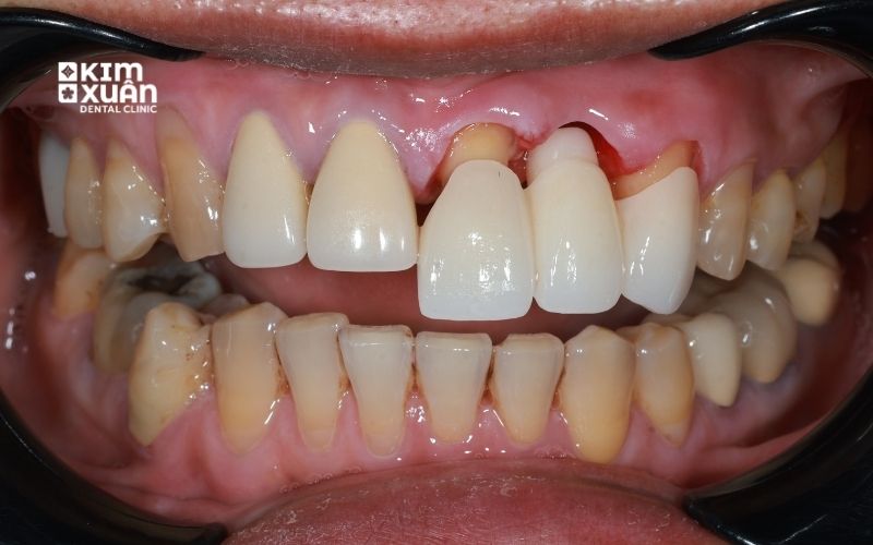 Hình Ảnh Làm Cầu Răng Sứ Bị Tiêu Xương Hàm