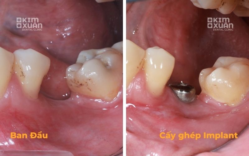 Hình Ảnh Mất Răng Trồng Răng Implant Thay Thế