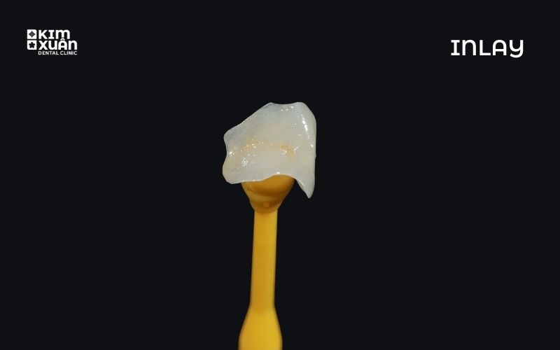 Hình Ảnh Miếng Trám Inlay
