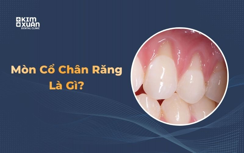 Hình ảnh mòn cổ chân răng