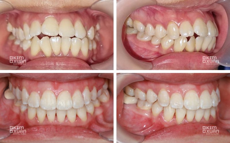 Hình ảnh người lơn niềng răng trước và sau tại nha khoa kim xuân