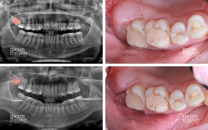 Hình Ảnh Nhận Biết Răng Khôn Mọc Ngầm