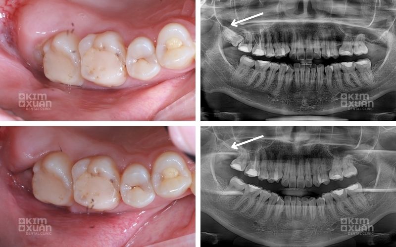 Hình Ảnh Nhổ Răng Khôn Tại Nha Khoa Kim Xuân