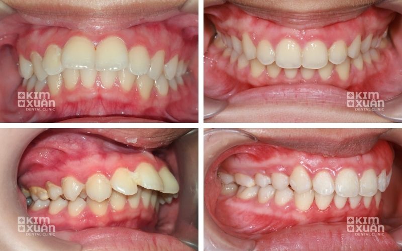 Hình Ảnh Niềng Răng Hô Ở Tuổi 17
