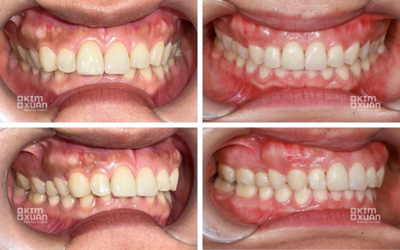 Hình ảnh niềng răng khớp cắn sâu tại nha khoa kim xuân