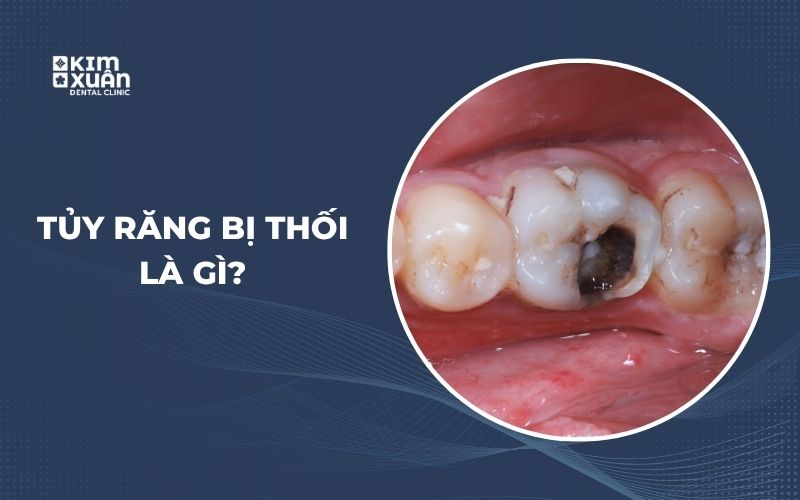 Răng Bị Thối Tủy