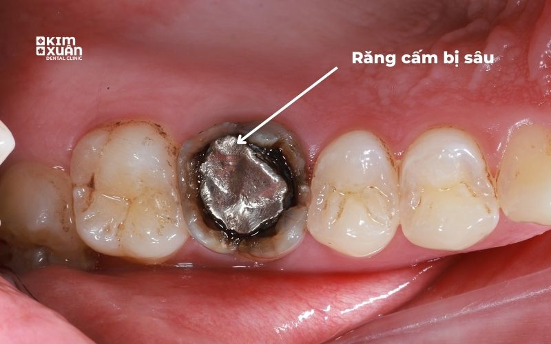 Hình Ảnh Răng Cấm Bị Sâu