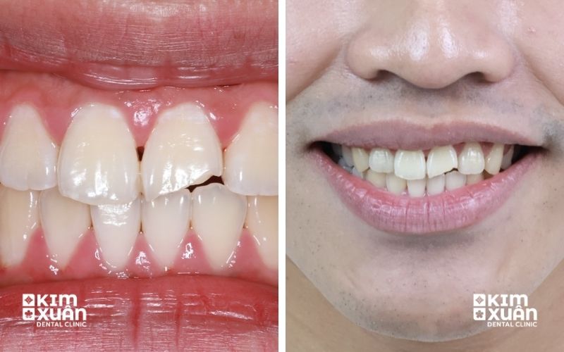 Hình Ảnh Răng Cửa Bị Mẻ