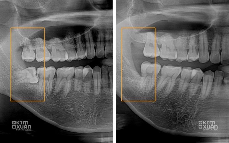 Hình ảnh răng khôn cần phải nhổ
