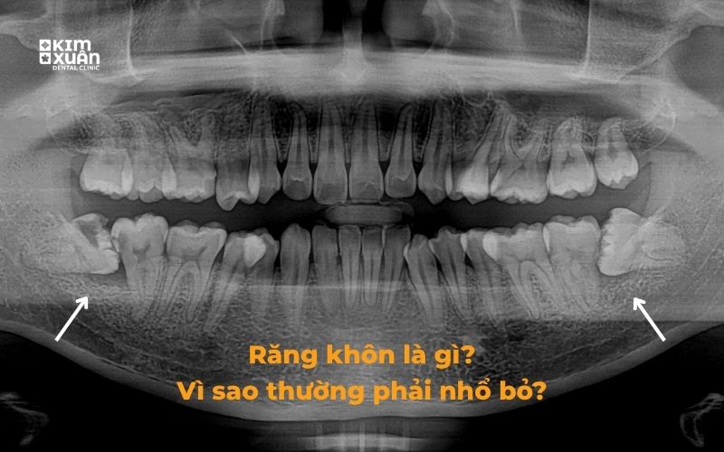 Hình ảnh răng khôn mọc nghiẻng khi chụp phim
