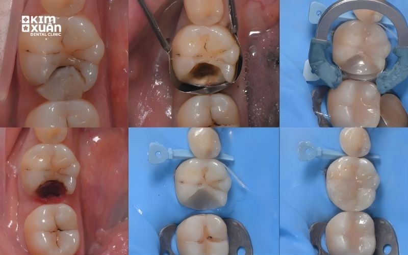 Hình Ảnh Răng Sâu Cần Phải Lấy Tủy Răng