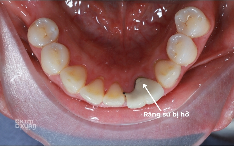Hình Ảnh Răng Bọc Sứ Bị Hở