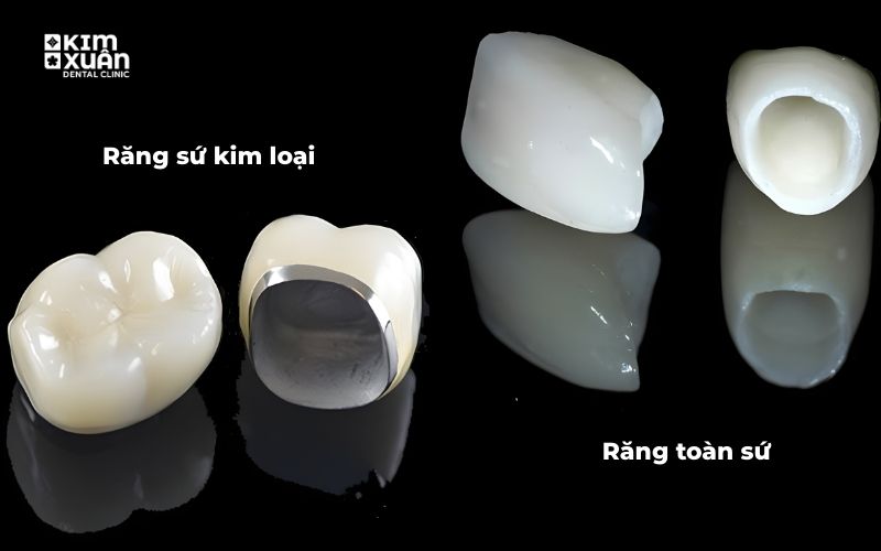 Hình Ảnh Răng Sứ Kim Loại Và Răng Sứ Toàn Sứ