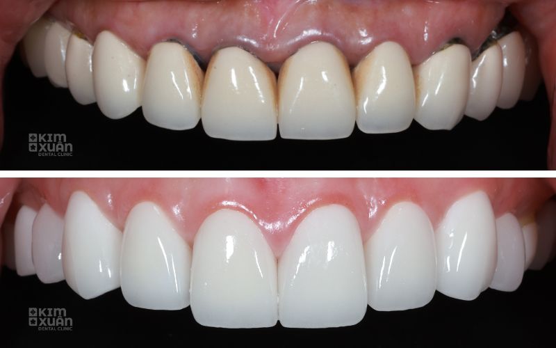 Hình Ảnh Răng Sứ Titan Và Răng Sứ Toàn Sứ