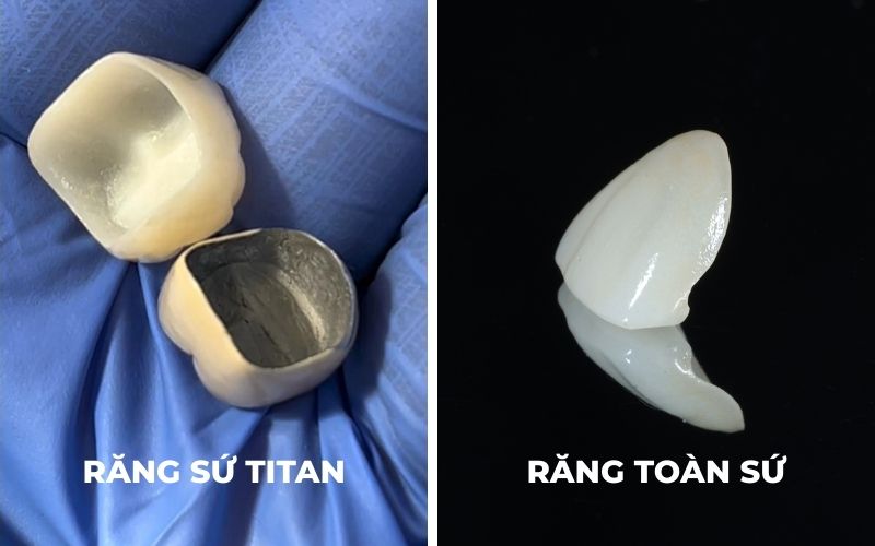 Hình Ảnh Răng Sứ Titan Và Răng Toàn Sứ