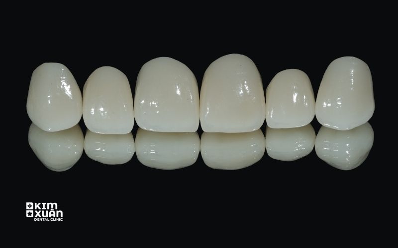 Hình Ảnh Răng Sứ Toàn Sứ