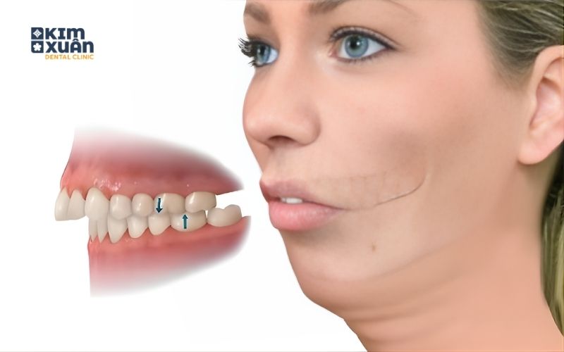 Hình Ảnh Răng Vẩu Do Xương