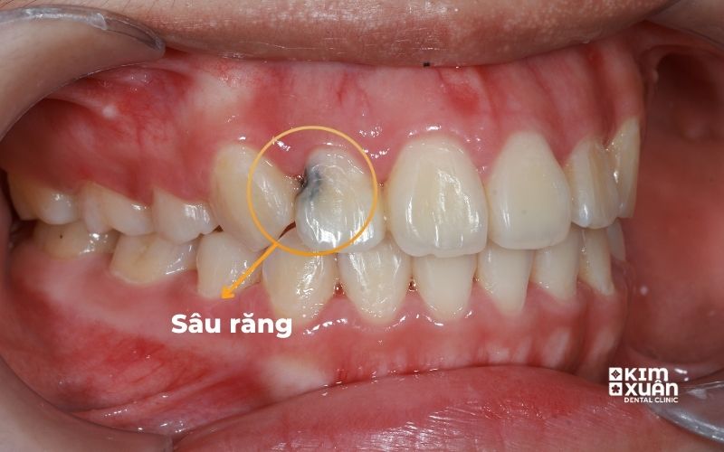 Hình Ảnh Bị Sâu Răng