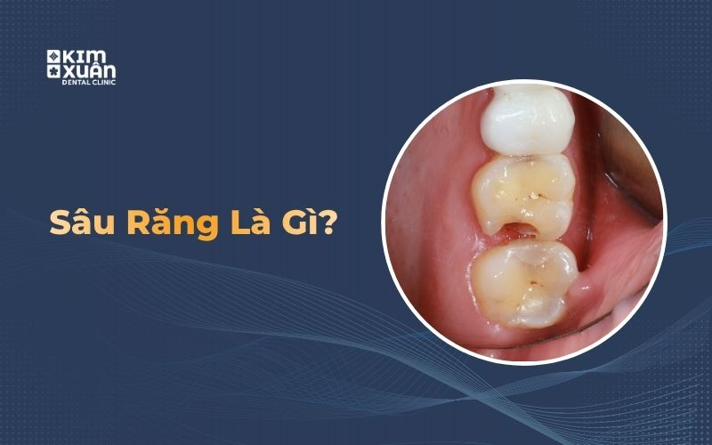 Hình ảnh sâu răng