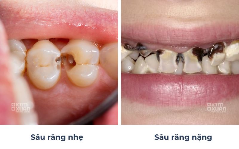 Hình Ảnh Sâu Răng Nặng Và Nhẹ Ở Trẻ Em