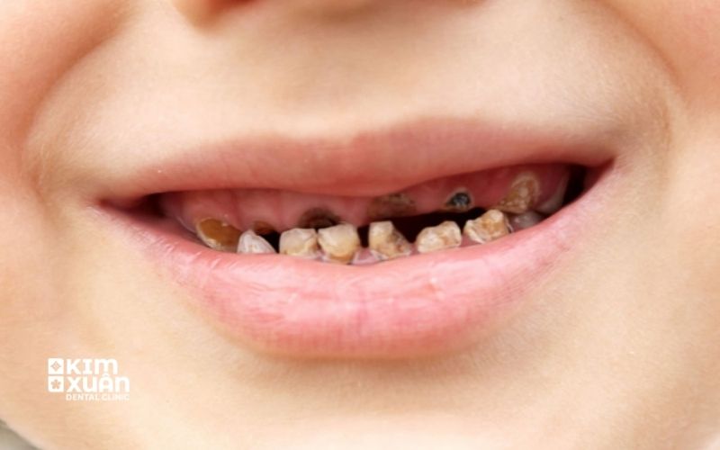 Hình Ảnh Sâu Răng Ở Trẻ Em