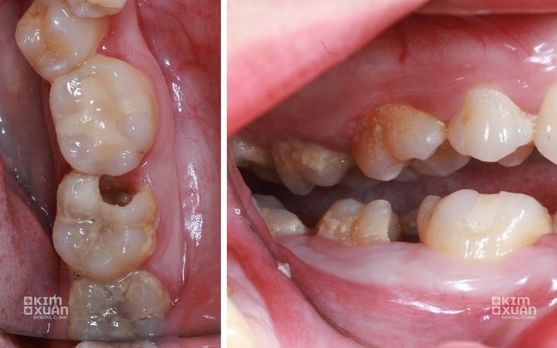 Hình ảnh sâu răng ở răng hàm