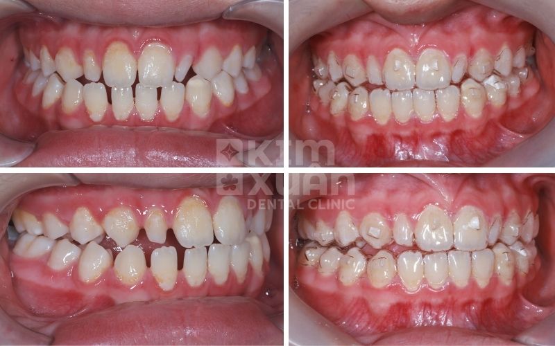 Hình Ảnh Thực Tế Khi Niềng Răng Tại Nha Khoa Kim Xuân
