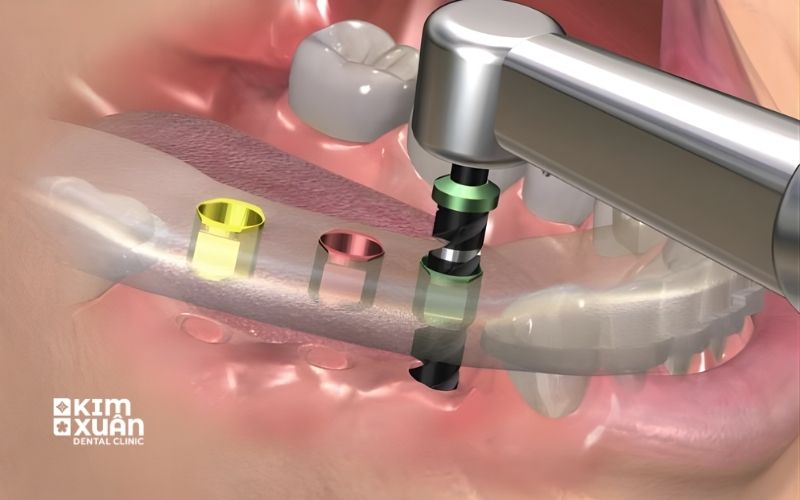 Hình Ảnh Trồng Răng Implant 