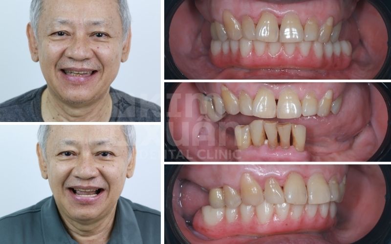 Hình Ảnh Trước Và Sau Khi Trồng Răng Implant All On 6 Tại Nha Khoa Kim Xuân
