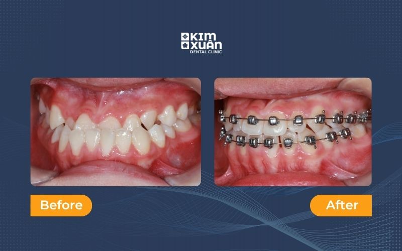 Hình ảnh trước và sau khi niềng răng mắc cài cánh cam tại nha khoa Kim Xuân
