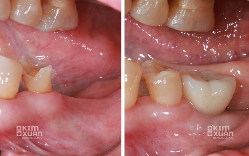 Hình Ảnh Trước Sau Khi trồng Răng Implant
