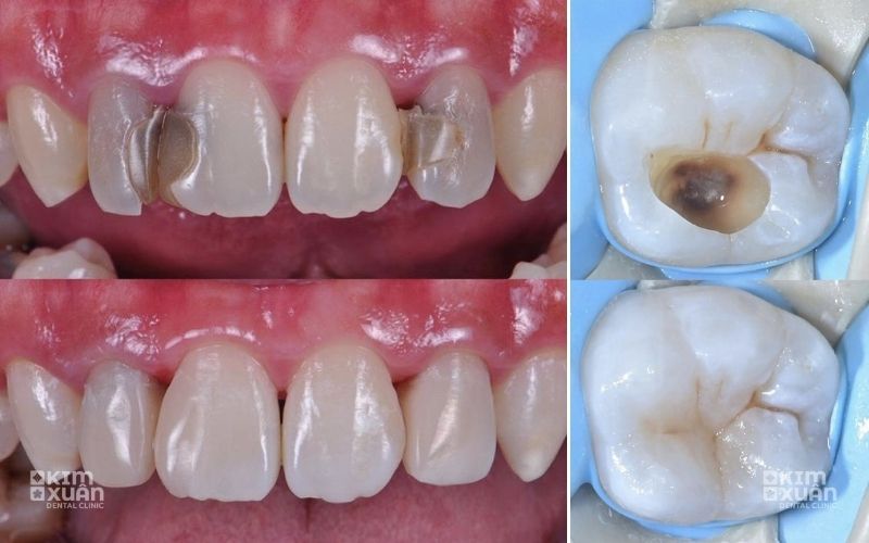 Hình Ảnh Trước Và Sau Khi Chữa Răng Sâu