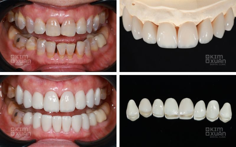 Hình ânhr truóc và sau dán răng sứ veneer tại nha khoa kim xuân