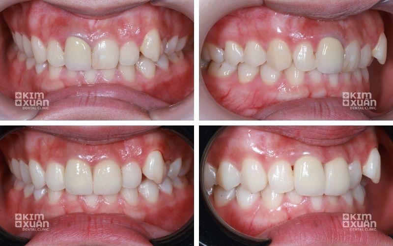 Hình Ảnh Trước Và Sau Khi Bọc Răng Sứ Tại Nha Khoa Kim Xuân 