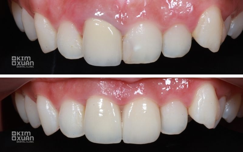 Hình Ảnh Trước Và Sau Khi Bọc Sứ 2 Răng Cửa