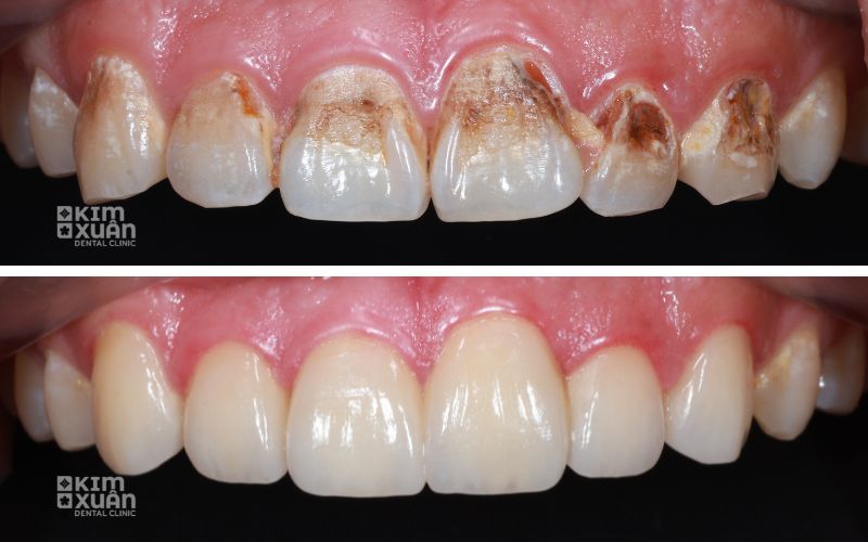 Hình Ảnh Trước Và Sau Khi Dán Răng Sứ Emax