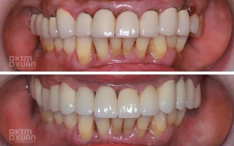 Hình Ảnh Trước Và Sau Khi Điều Trị Chân Răng Bị Đen