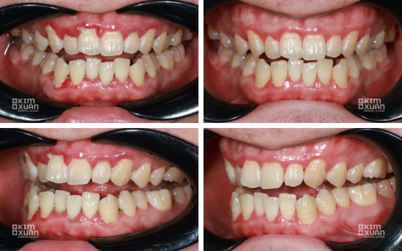 Hình ảnh trước và sau khi điều trị nướu sưng đỏ