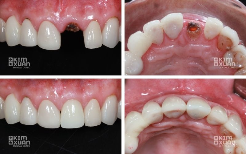 Hình Ảnh Trước Và Sau Khi Điều Trị Răng Gãy