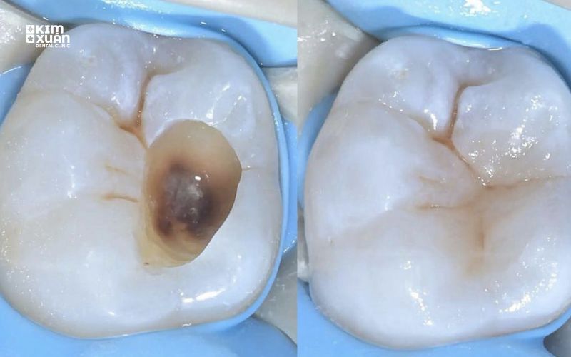Hình ảnh trước và sau khi điều trị tủy răng