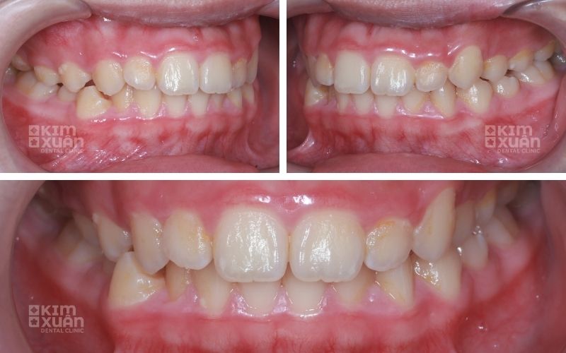 Hình Ảnh Trước Và Sau Khi Điều Trị Viêm Lợi Ở Trẻ Em