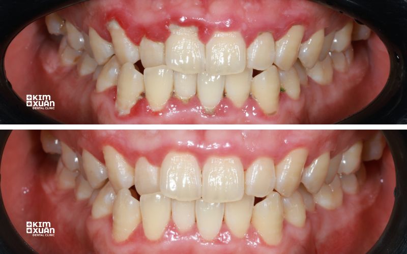 Hình ảnh trước và sau khi điều trị viêm nha chu